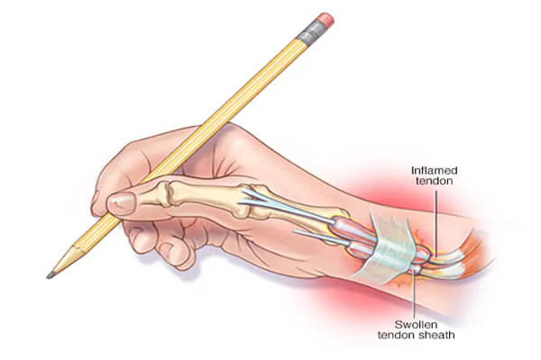 Imagen decorativa Tenosinovitis Quervain